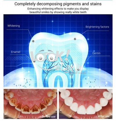 LANBENA Teeth Whitening For Dental treatment 